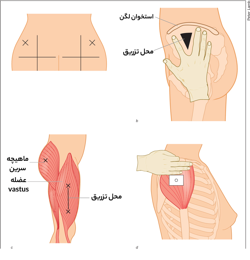 مکان تزریق با سوزن‌های عضلانی