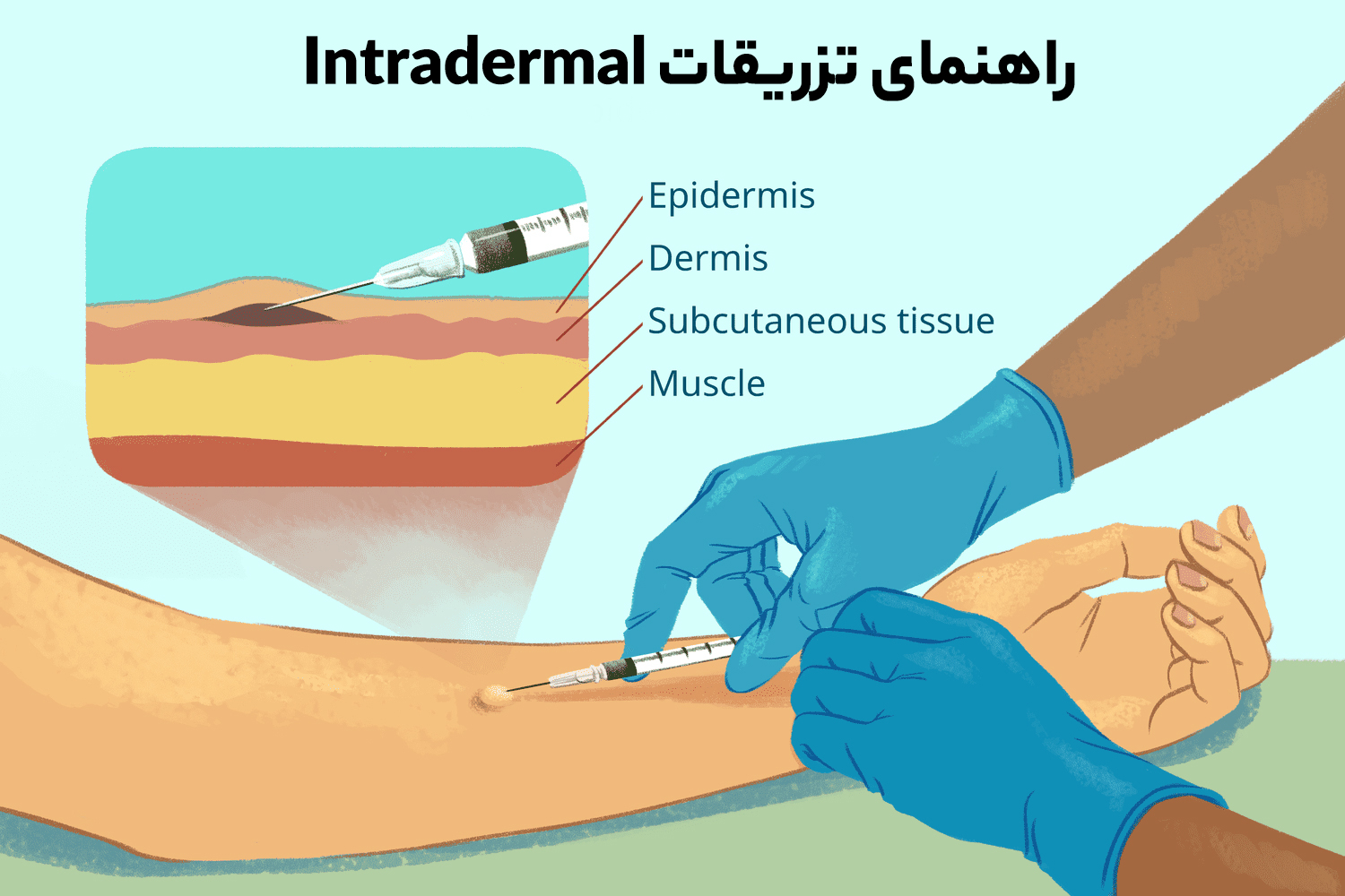 سوزن تزریقات Intradermal