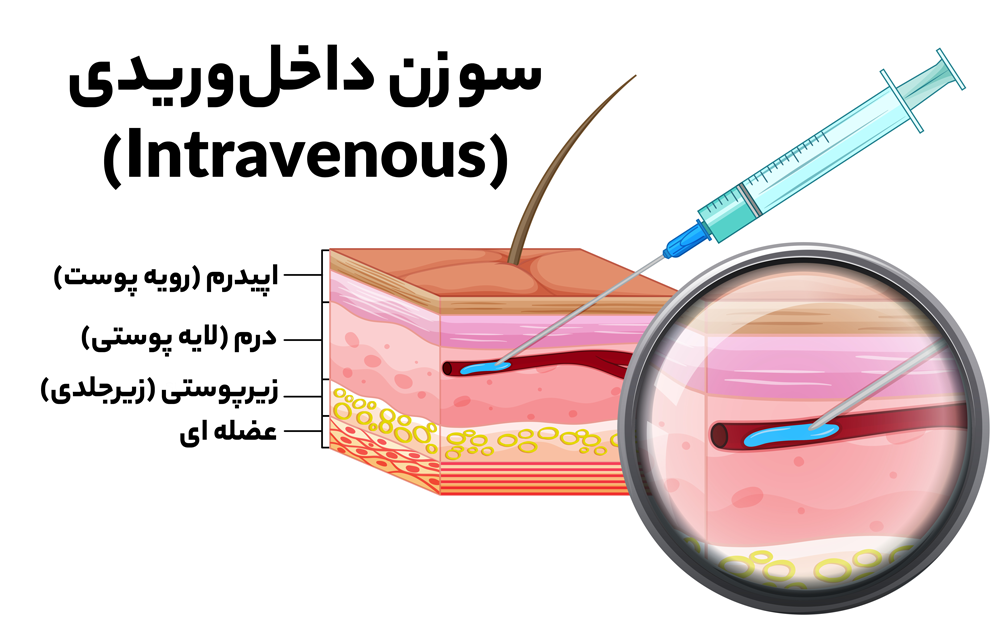 سوزن-تزریقات-داخل‌وریدی-(Intravenous)